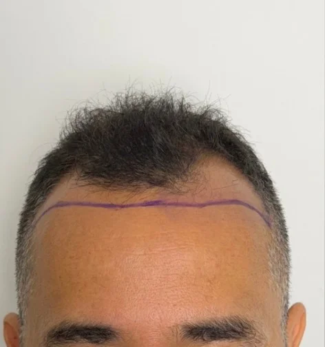 Antes injerto capilar